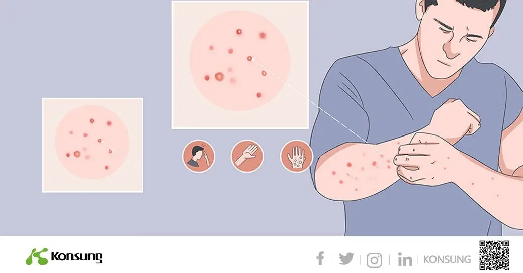 World Health Organization confirms 92 cases of monkeypox with outbreaks in 12 countries